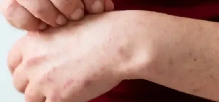 Sigue en aumento el brote de sarampión en México