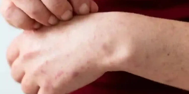 Sigue en aumento el brote de sarampión en México