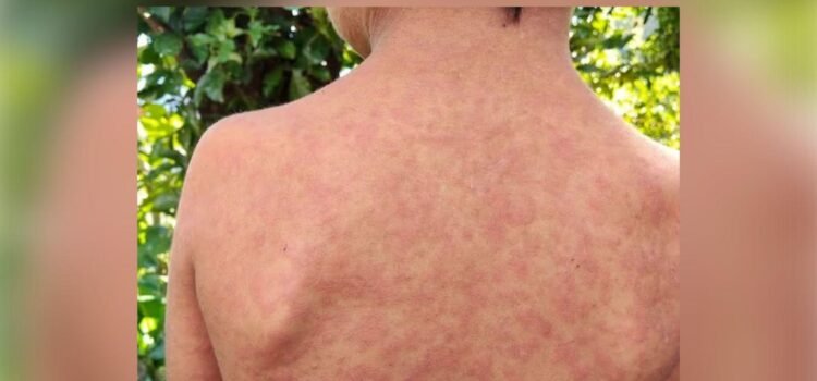 Alerta en Colima por sarampión, 30 casos sospechosos Alerta en Colima por sarampión, 30 casos sospechosos