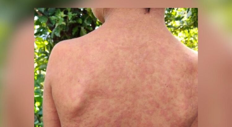 Alerta en Colima por sarampión, 30 casos sospechosos